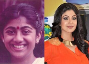 18 Famous Celebs Who Went Under The Knife To Get That Look Tomatoheart.com 7